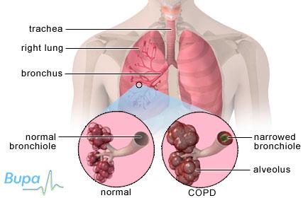 chronic-obstructive-pulmonary-disease