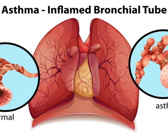 An image of an asthma-inflamed bronchial tube on a white background